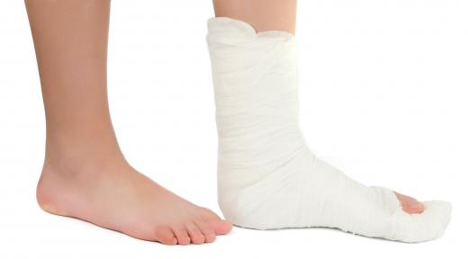 A person wearing an orthopedic cast made with gypsum plaster.