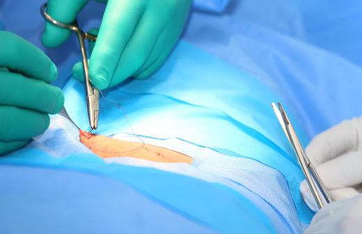 Super Glue is similar to a cyanoacrylate frequently used for bonding surgical incisions.